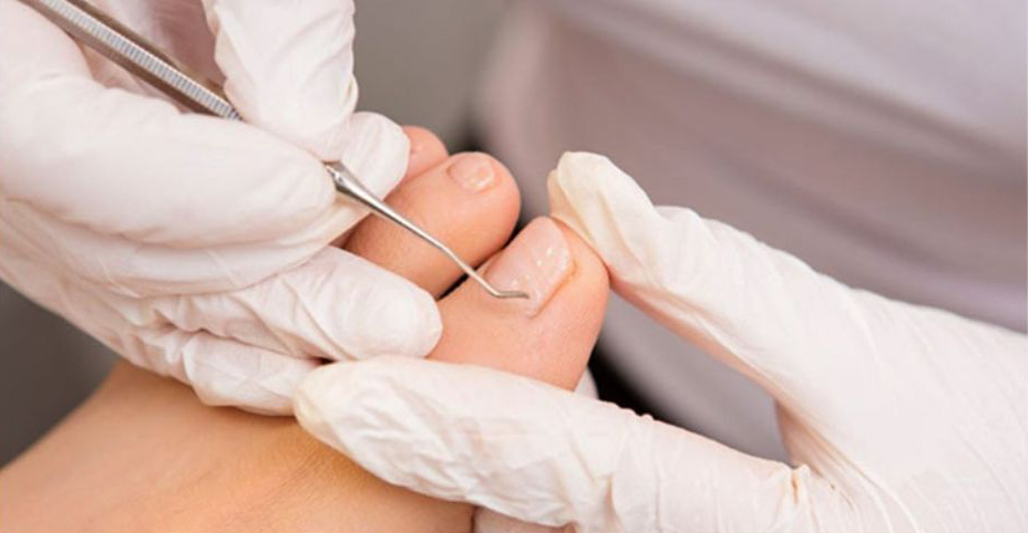Nail Surgery